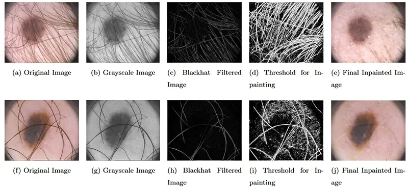 خروجی های روش نقاشی درون تصویر مورد استفاده برای حذف مصنوعات در مجموعه داده PH2: (الف) و (و)- تصاویر اصلی. (b) & (g)- تصاویر مربوط به مقیاس خاکستری؛ (ج) و (h)- تصاویر فیلتر شده Blackhat. (د) و (i) - آستانه برای عملیات رنگ آمیزی. (e) و (j) - تصاویر از پیش پردازش شده نهایی (داخلی).